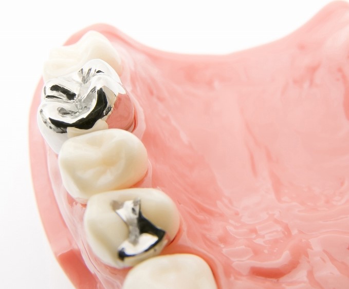 銀歯がおよぼす影響